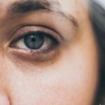 como-quitar-las-ojeras